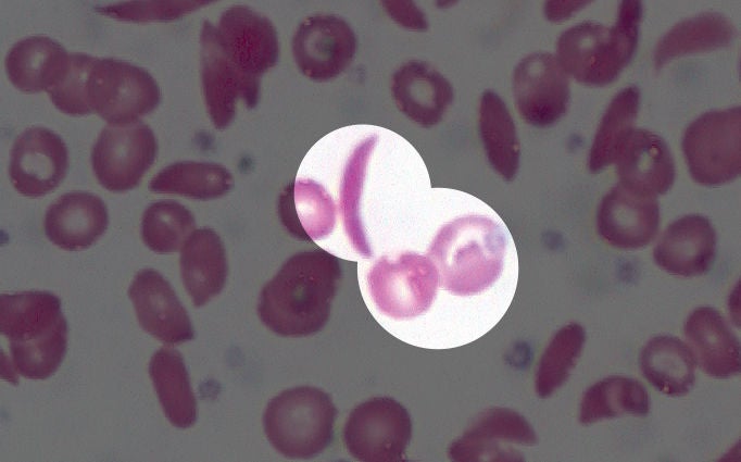 sickle cells